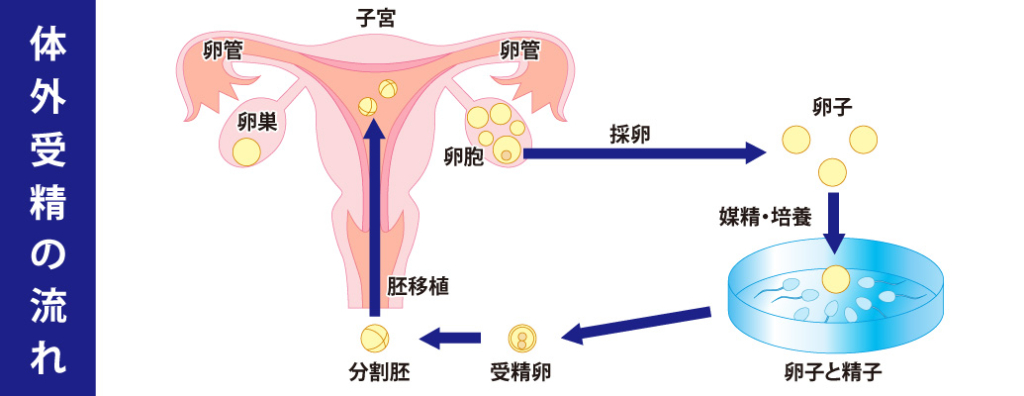 体外受精の採卵に伴う痛みの程度は 健康新聞デジタルニュース